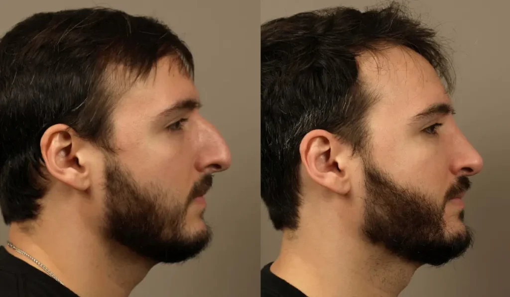 Rhinoplasty 