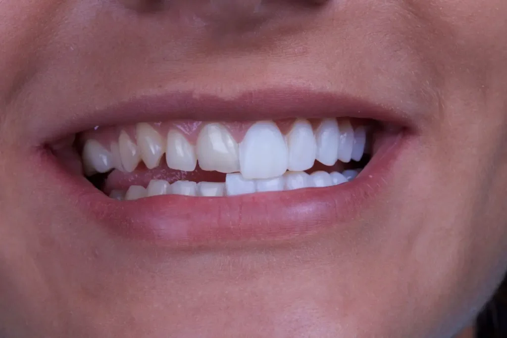 Teeth Whitening